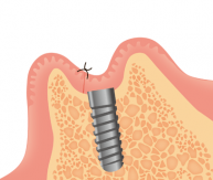 人工歯根（フィクスチャー）埋入